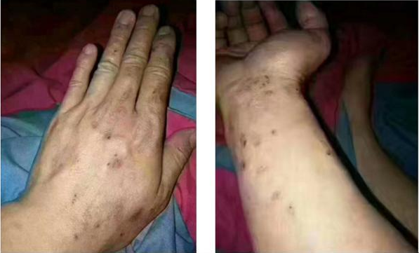 美縫劑過敏 美縫劑過敏